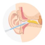 Drenaż uszu u dzieci opinie rodziców i efekty zdrowotne 717